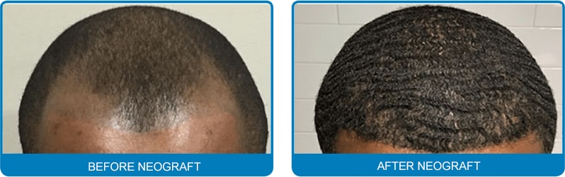 Hair-Transplant-New-Mexico-11 New Mexico hair Loss