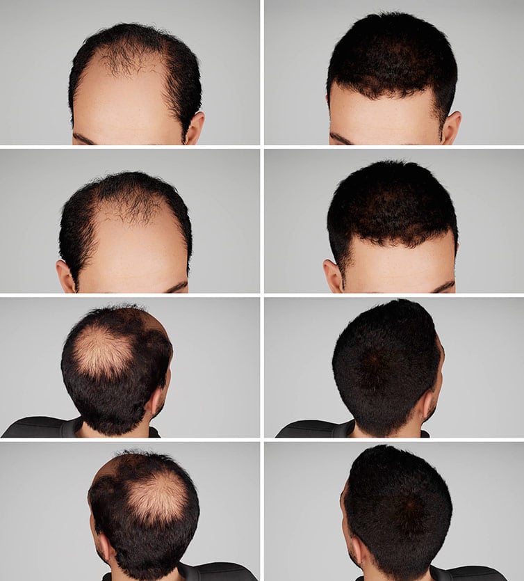 hair-restoration New Mexico hair Loss
