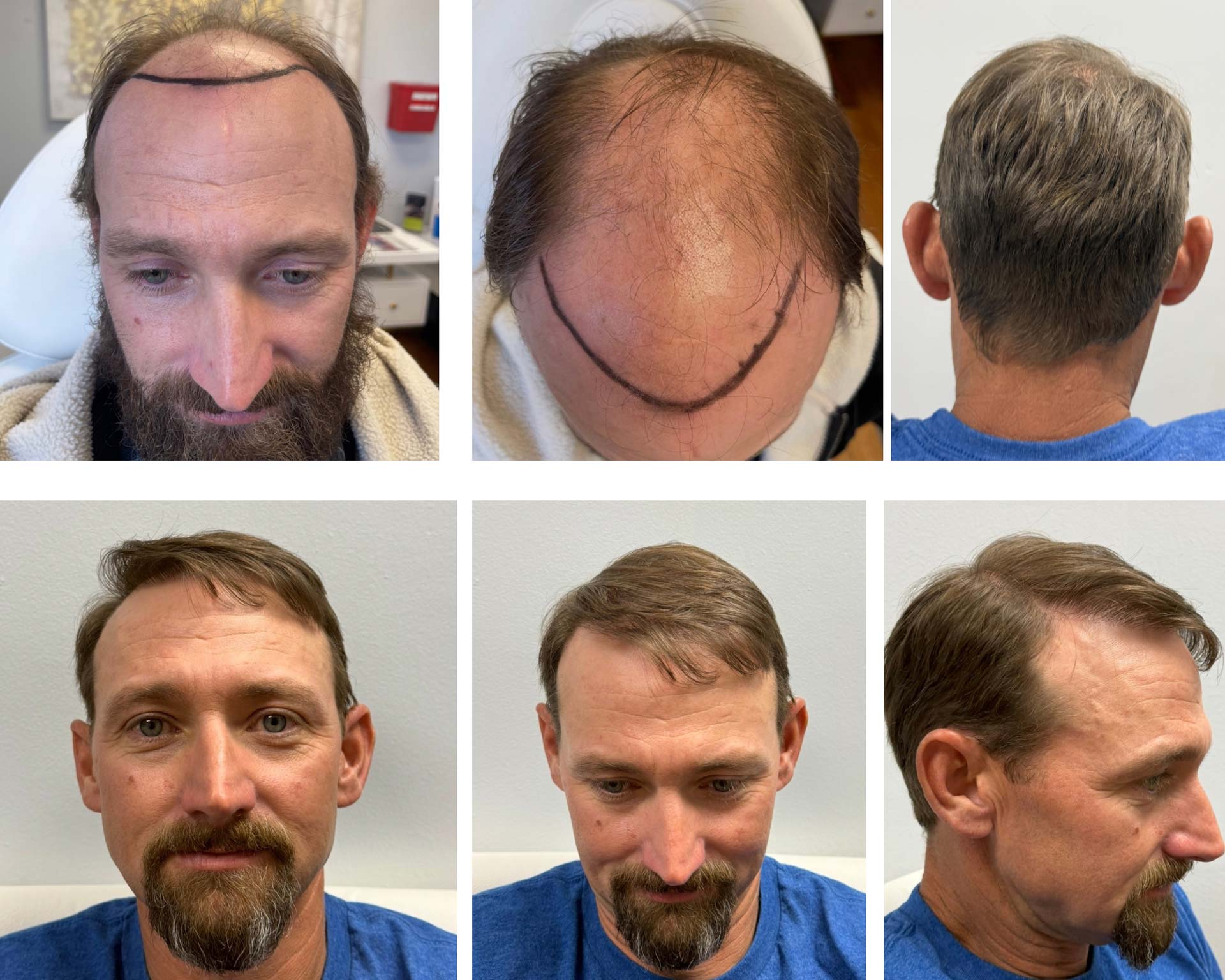precision_medical_hair_before_after